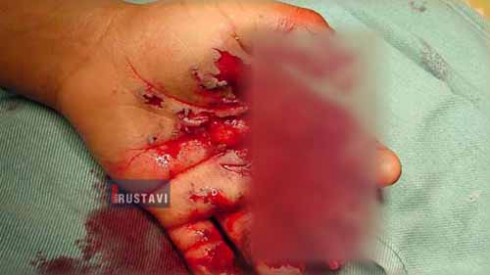 პიროტექნიკით 50-მდე ადამიანი დაშავდა