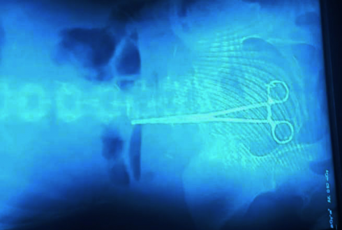 "ექიმებს ოპერაციის დროს მაკრატელი მუცელში დარჩათ" [video]