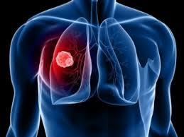 კიბოს დიაგნოზით 7388 ადამიანი გარდაიცვალა