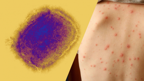 მაიმუნის ყვავილით გარდაცვალების გეოგრაფიული მასშტაბი გაიზარდა