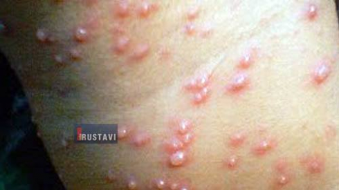 სეზონური ვირუსული დაავადებები