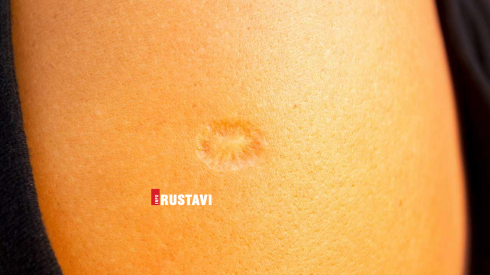 ამარცხებს, თუ არა ტუბერკულიოზის ვაქცინა კორონავირუსს