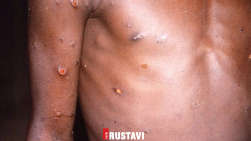 რა სიმპტომები აქვს მაიმუნის ჩუტყვავილას და როგორ ვრცელდება