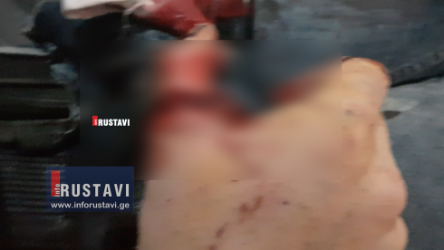რუსთავში ბავშვებმა თითები დაკარგეს [video]