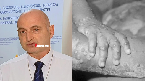 ვისთვის არ წარმოადგენს საშიშროებას "მაიმუნის ყვავილი"