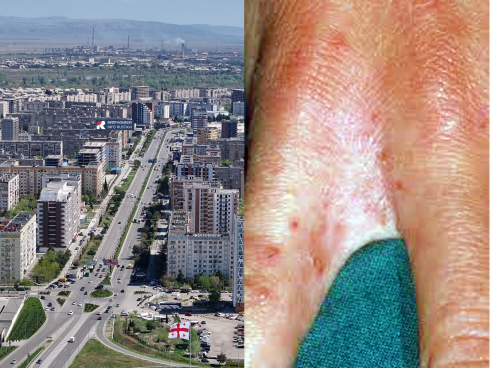 ფიქსირდება თუ არა რუსთავში მუნის შემთხვევები